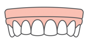 An illustration of an implant supported arch