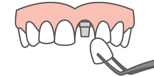 A single dental implant crown being placed